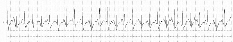 Sinus Tachycardia Rhythm Strip